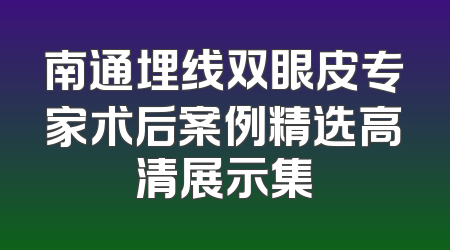 南通埋线双眼皮专家术后案例精选高清展示集